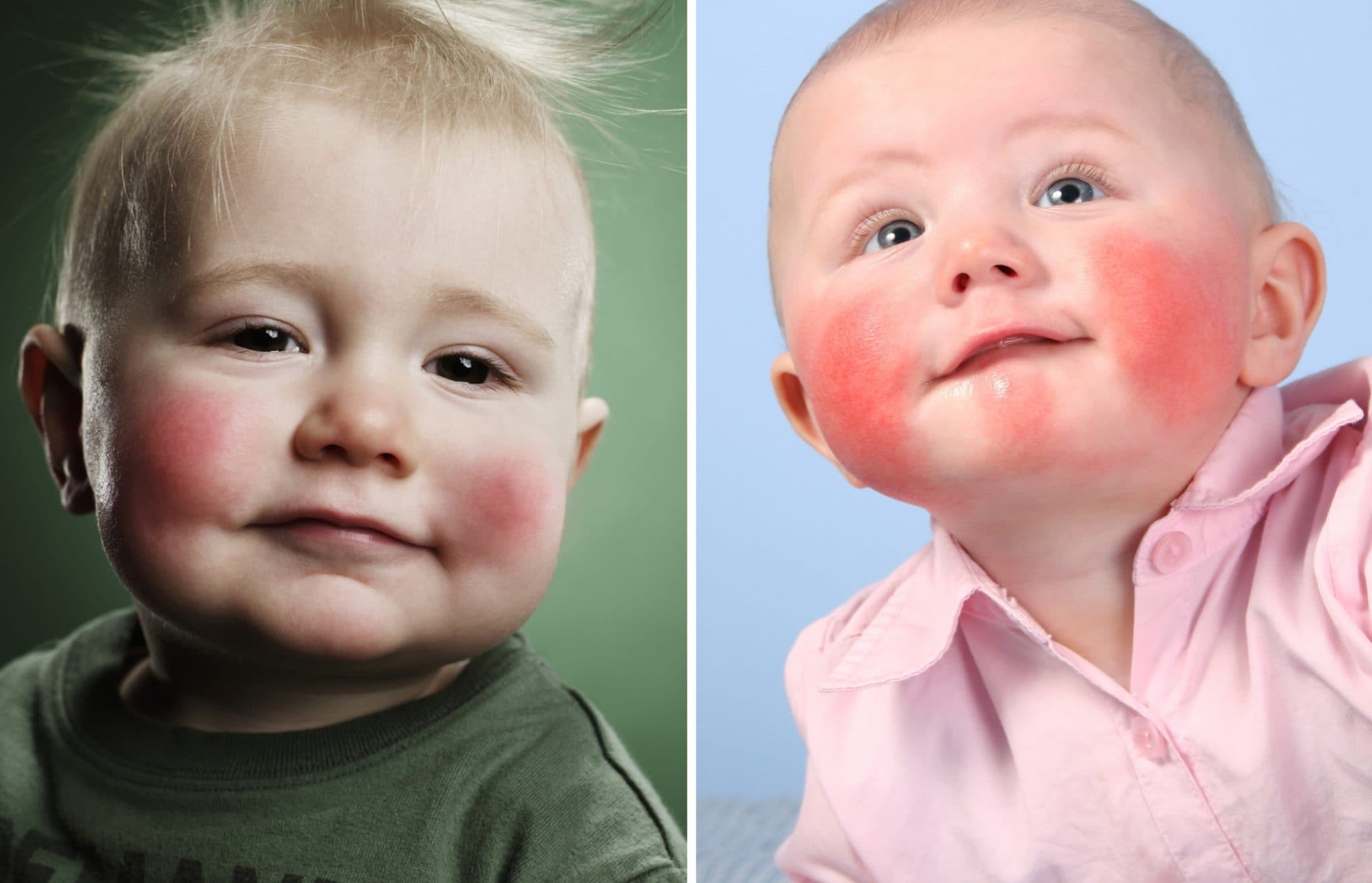 диатез у детей на щеках